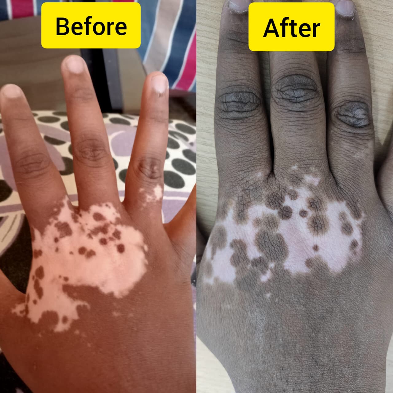 Vitiligo Improvement with Ayurvedic Treatment: A Natural Healing Approach